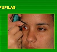 Image result for Tipos De Pupilas En Enfermeria
