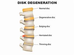 Image result for C4 to C5 Herniated Disc Symptoms