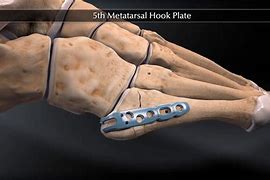 Image result for 5th Metatarsal Hook Plate
