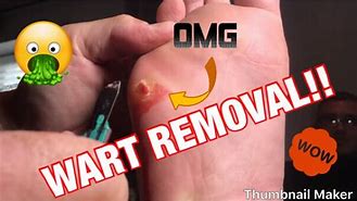 Image result for How to Remove Plantar Warts