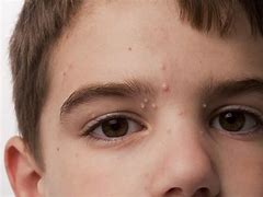 Image result for Molluscum Contagiosum Over the Counter