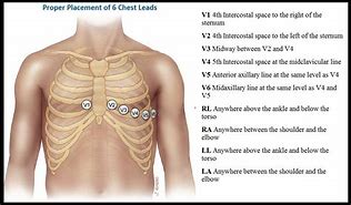 Image result for Chest Lead Placement