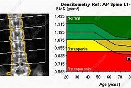 Image result for Osteoporosis Bone Scan