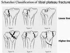 Image result for Lateral Tibial Condyle Fracture