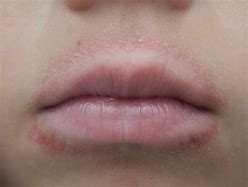 Image result for Rash around the Mouth
