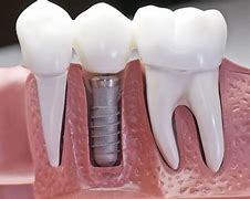 Image result for Dental Restoration Types