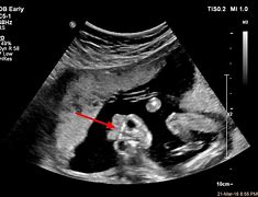 Image result for Anencephaly Ultrasound Frog Eye Appearance