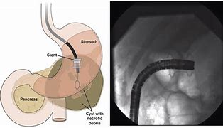 Image result for Drainage Stent