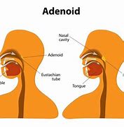 Image result for adenoidea