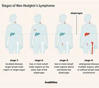 Image result for Non-Hodgkin Lymphoma