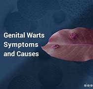 Image result for NIH Genital Warts