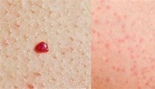 Image result for Rashes and Bumps