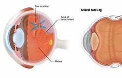 Image result for Eye Retina and Band Surgery