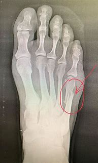 Image result for Fifth Metatarsal Pain