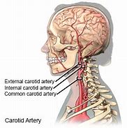 Image result for Carotid Artery Neck Pain