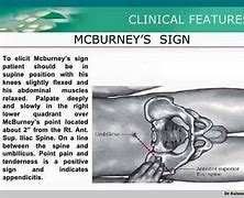 Image result for McBurney and Murphy's Sign