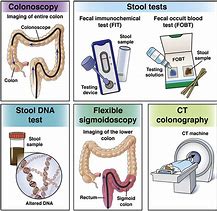 Image result for Colon Cancer Stool Pics