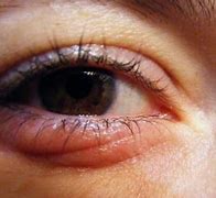 Image result for Red Swelling Under Eye
