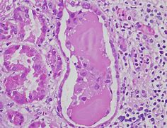 Image result for Myeloma Cast Nephropathy
