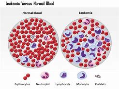 Image result for Normal Blood vs Leukemia