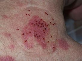 Image result for Bed Bug Bites On Neck