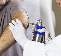 Image result for Cryotherapy Wart Removal
