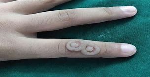 Image result for Salicylic Acid Wart Removal Process