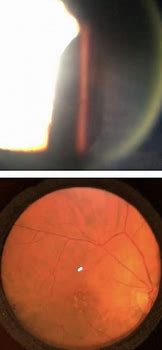 Image result for Slit Lamp Retina