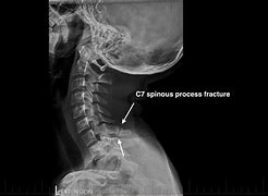 Image result for Broken Back X-ray