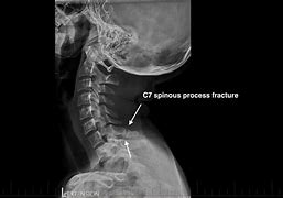 Image result for C7 Fracture Symptoms