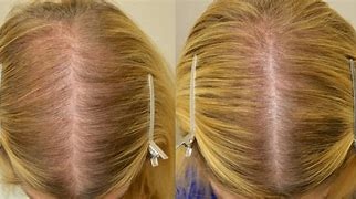Image result for Unwanted Hair Growth in Minoxidil