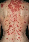 Image result for Lupus Skin Rash