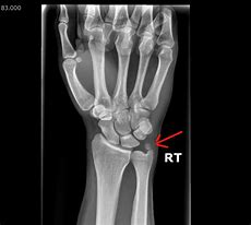 Image result for Calcified Bone Chips