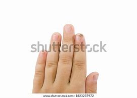 Image result for Finger Papilloma