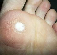 Image result for Salicylic Acid for Warts