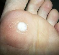 Image result for Warts After Treatment