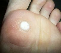 Image result for Plantar Wart Side of Foot