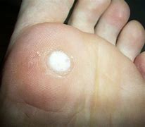 Image result for Plantar Warts On Feet Removal
