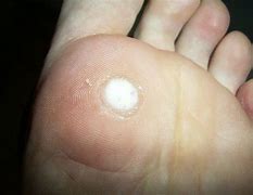 Image result for Permanent Genital Wart Removal