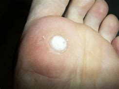 Image result for Wart Removal Anatomy