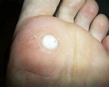 Image result for Genital Wart Removal Surgery