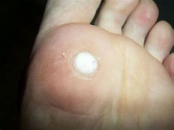 Image result for Best Wart Removal Products