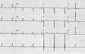 Image result for Old Anterior Infarct ECG