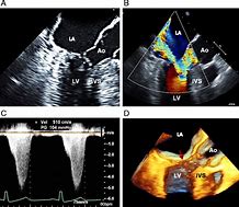 Image result for Sam of Mitral Valve