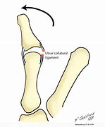 Image result for Radial Collateral Ligament Thumb
