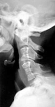 Image result for Congenital Cervical Spine Fusion