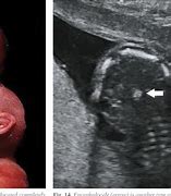 Image result for Fetal Acrania