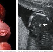 Image result for Anencephaly Images