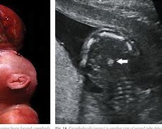 Image result for Anencephaly Ultrasound Diagnosis