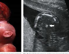 Image result for Anencephalic Infant
